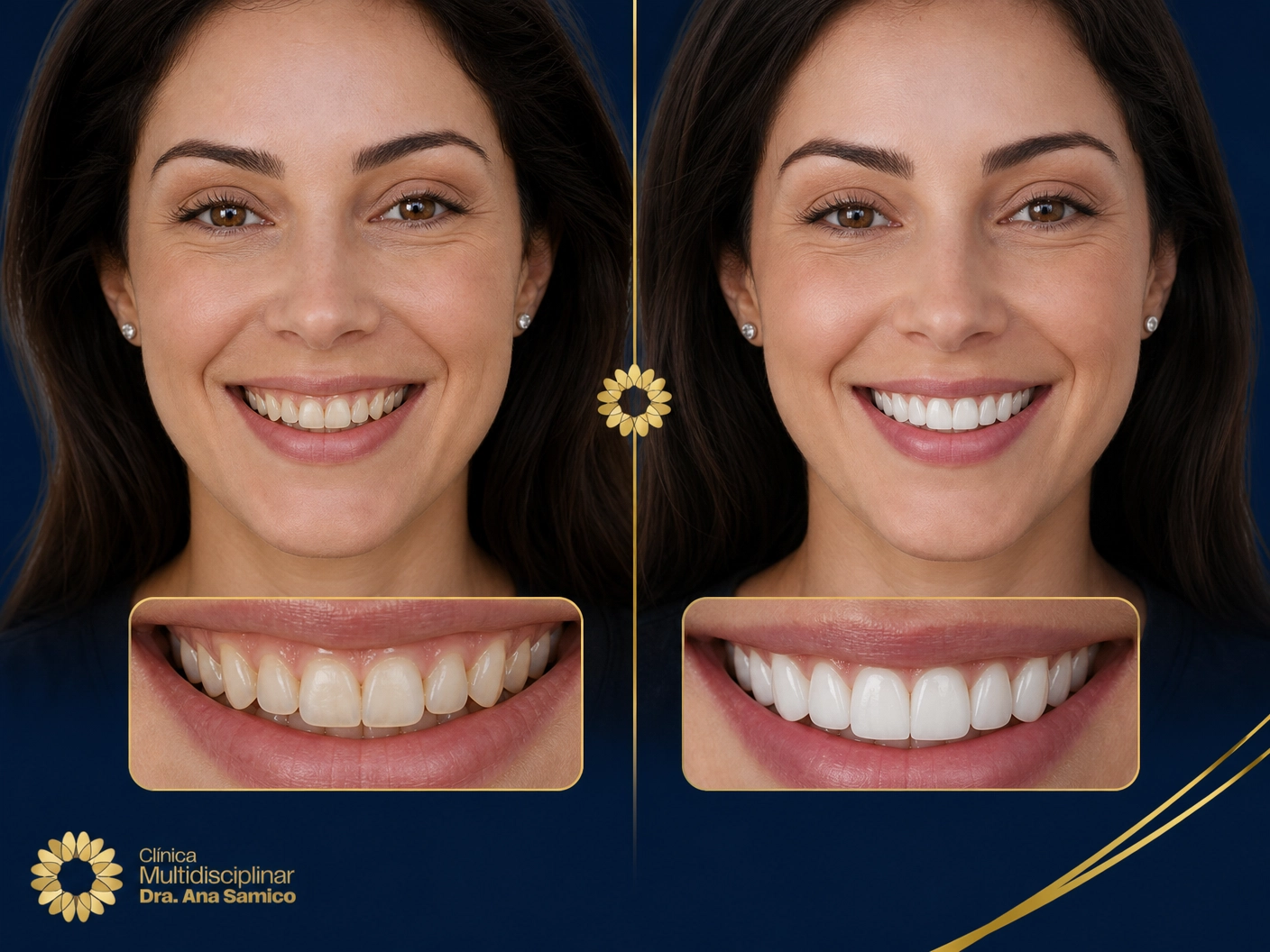 Comparativo visual de resultado estético com lentes de contato dental